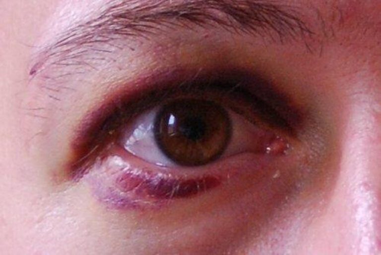 Contusion vs Hematoma: Understanding the Differences