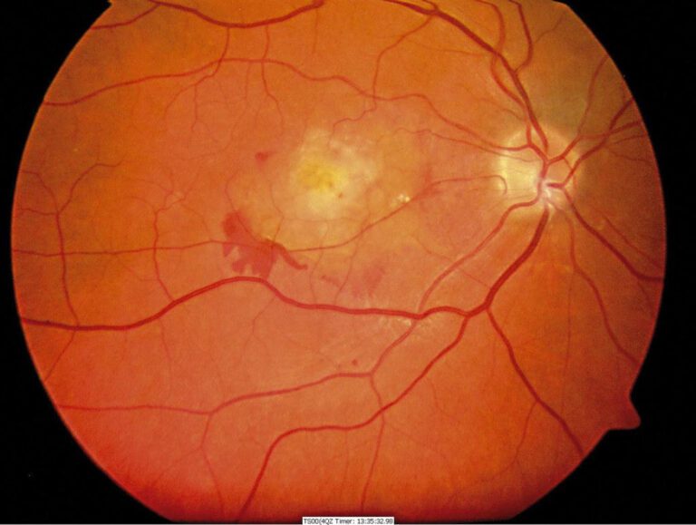 Expert Care for Retinal Disorders at Colorado Retina Associates