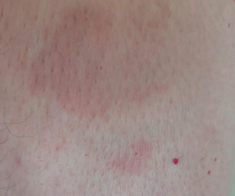 Stress Rash on Neck: Causes and Treatments