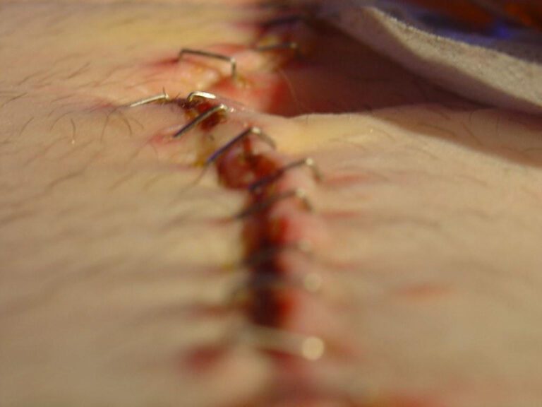 Understanding the jpouch: What you need to know