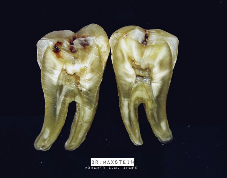 The Tooth Truth: How Thumb Sucking Wrecks Your Bite