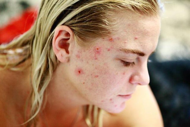 Why Do Pimples Hurt: The Science Behind the Pain