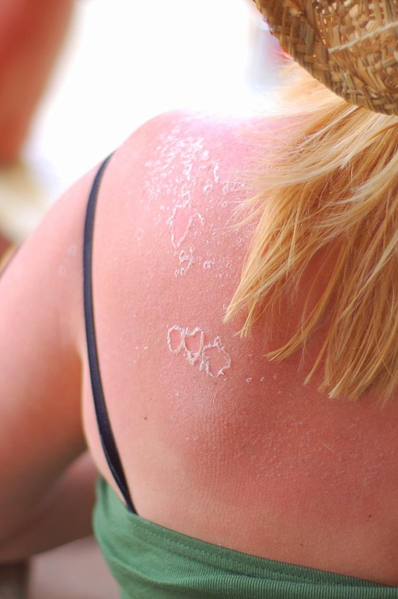 Understanding Sunburned Eyes