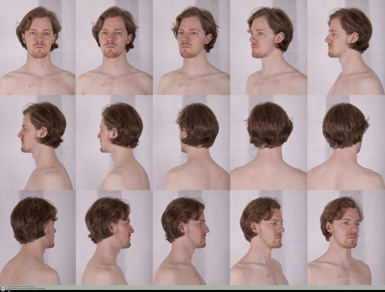 Understanding Head Pimples: Causes and Treatments