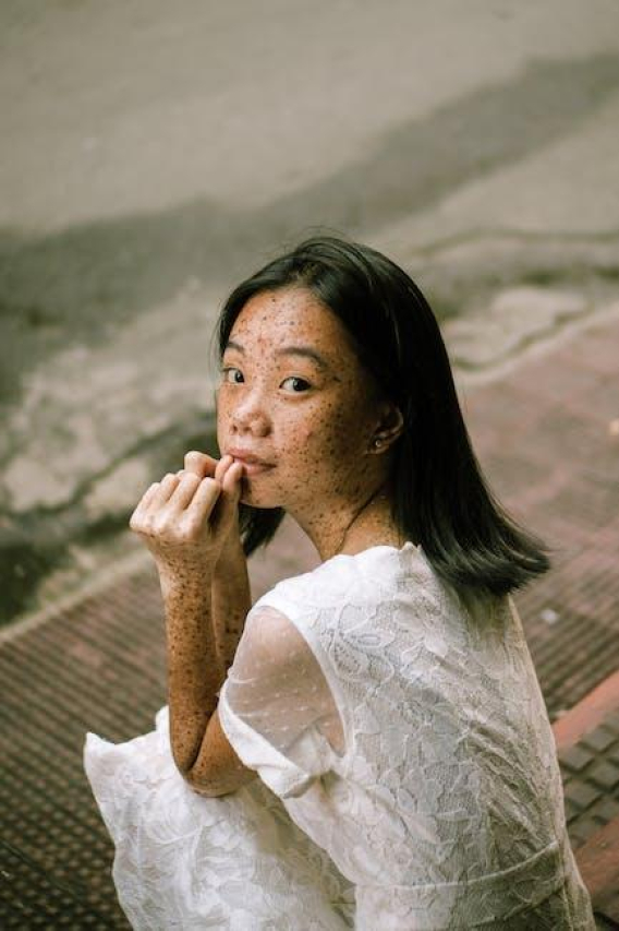Understanding and Treating Pimple on Eyelid