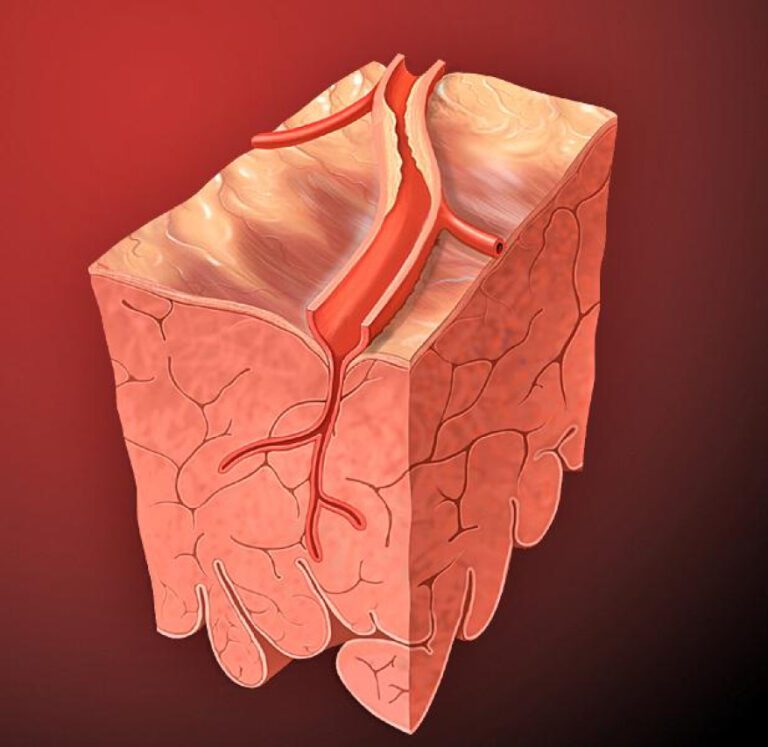 Understanding Venofer: What You Need to Know