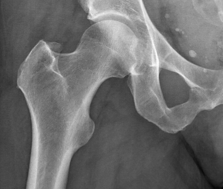 Pain in Front of Hip: Causes and Treatment Options