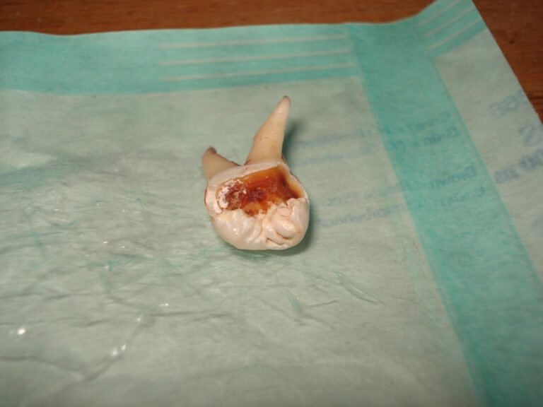 The Price of Pearly White Pain: Tooth Pulling Costs