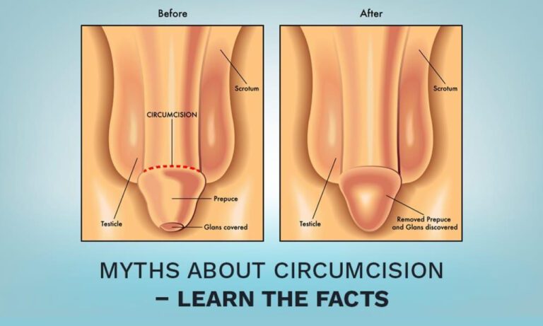 The Cost of Out-of-Pocket Vasectomy Procedures