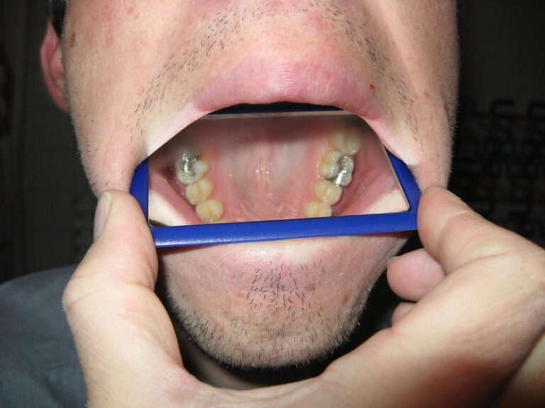 The High Cost of Being Unfilled: Fillings sans Insurance