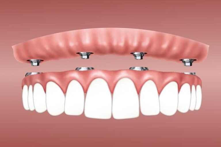 Dental Implant Costs: Insurance Coverage Explained