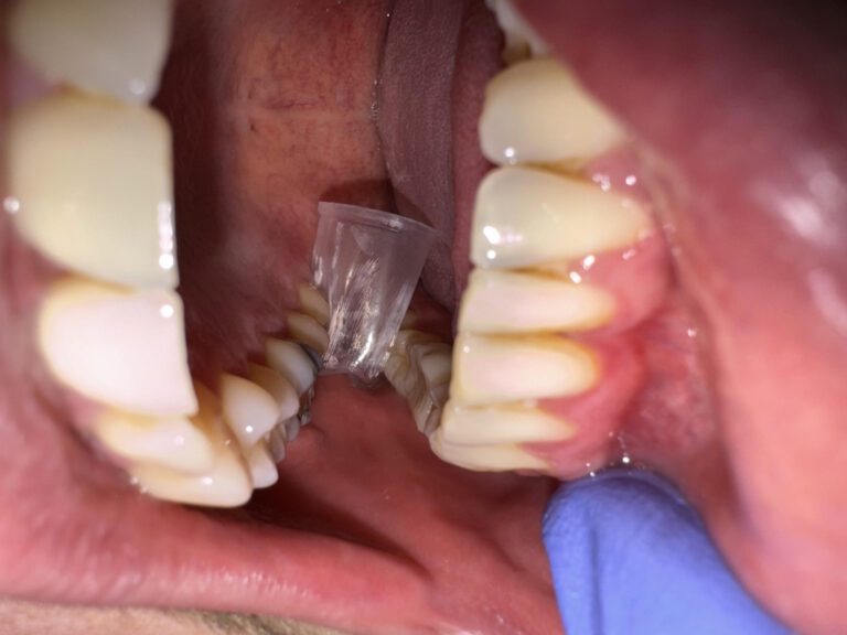 Wisdom Teeth Removal Cost: Complete Guide