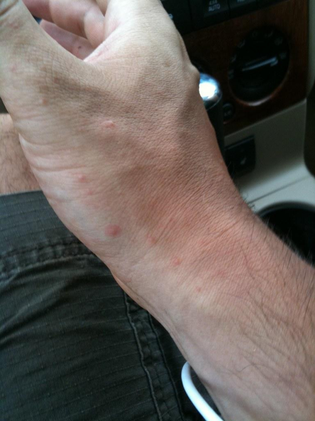 Can Sun Poisoning Be Fatal? The Truth Revealed