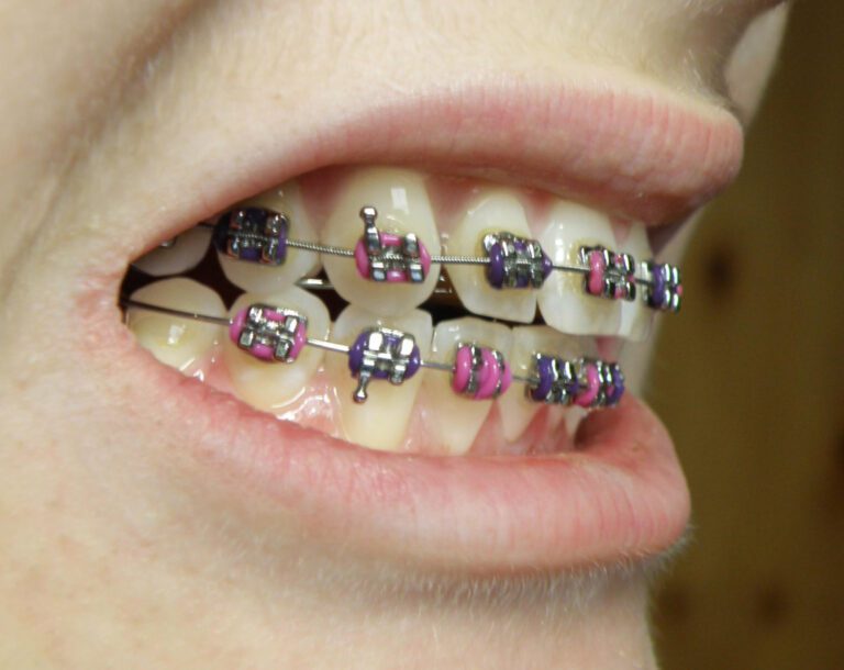 The Cost of Braces: What to Expect in 2021