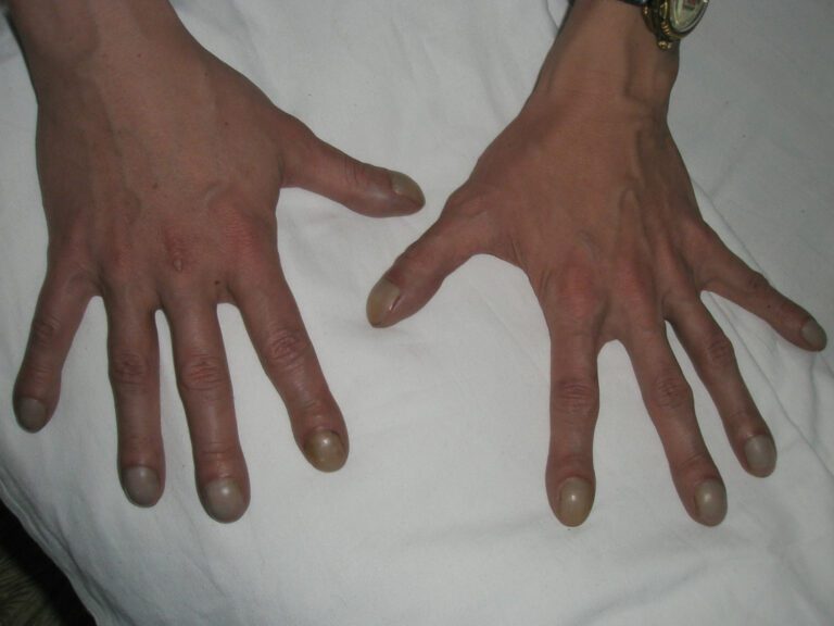 Clubbed Thumbs: The Quirky Trait You Never Knew About!
