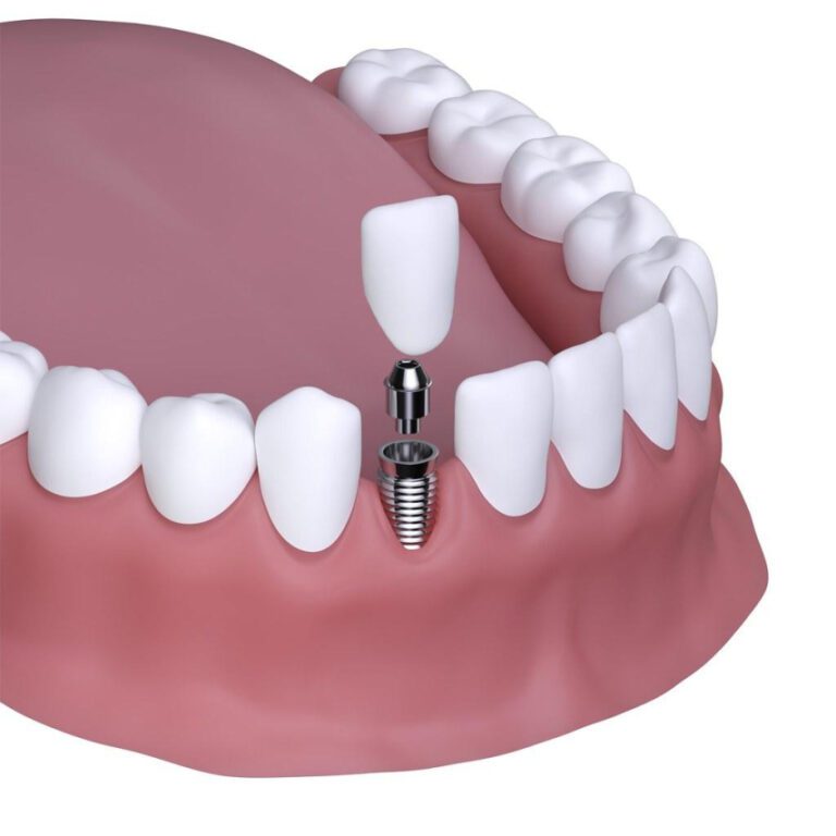 The Price of a Single Tooth Implant: What to Expect