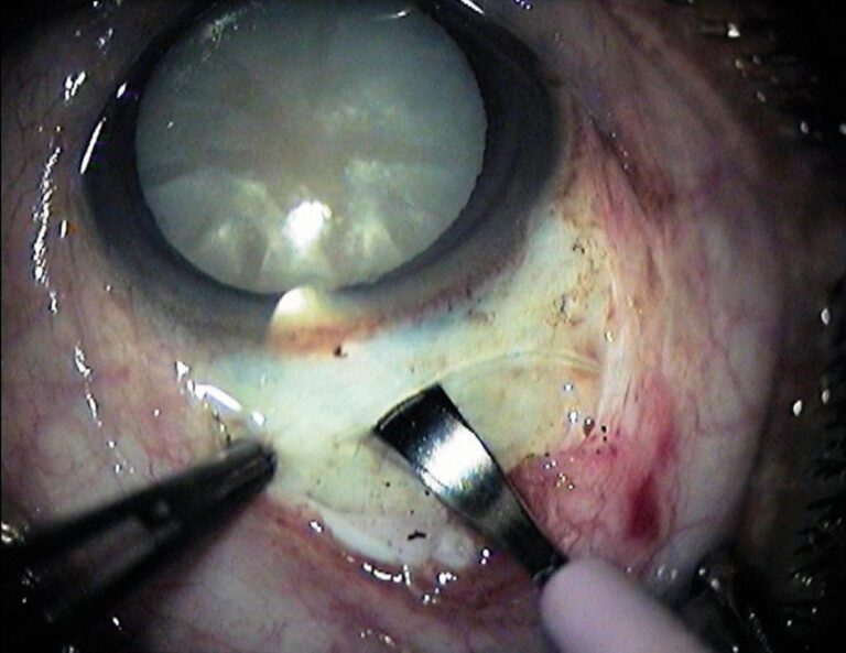 The Price of Cataract Surgery: A Complete Guide