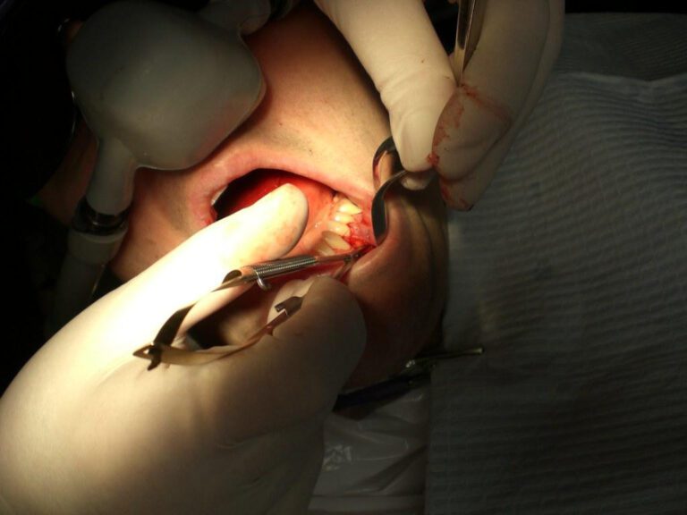Understanding Gum Surgery Costs: What to Expect
