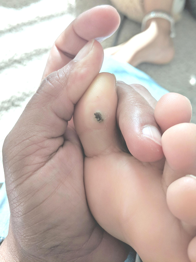 Can You Safely Cut Off a Wart? Expert Advice