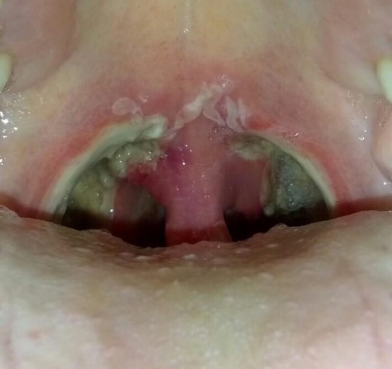 Tonsillectomy Cost: Understanding the Expenses