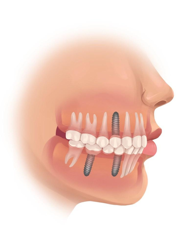 Understanding the Cost of Full Mouth Implants
