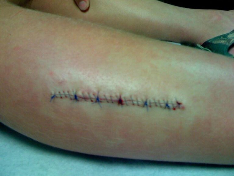 When Do You Need Stitches? Signs, Symptoms, and Treatment