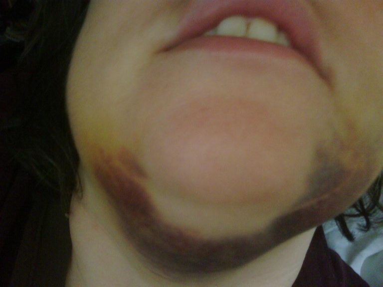 Cover Up Facial Bruises Naturally with These Simple Tips